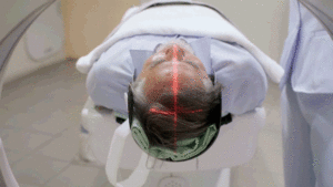 Новое исследование выявило связь между редким сосудистым заболеванием мозга и повышенным риском развития деменции у пожилых