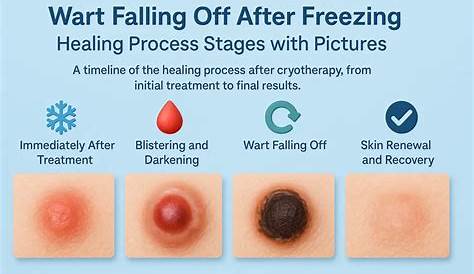 Замораживание этапов бородавки Падение оффкомпании Посадка Wrt Flling F Heling Путешествие Хелинг Выборы