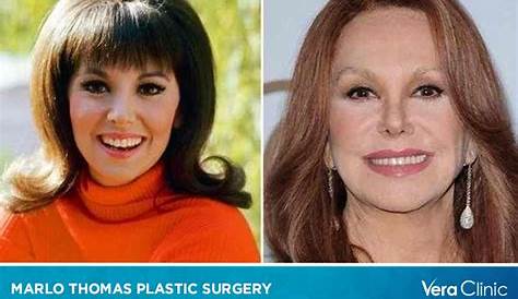 Марло Томас: Слишком много поклонников пластической хирургии думают, что они ушли далеко с помощью операций