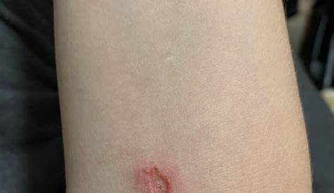 Вонючий жук сжигает кожу на Youtube