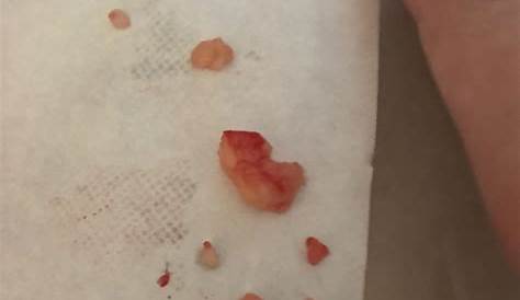 Кист на моей ноге взорвался или день получил все это из него он закончился