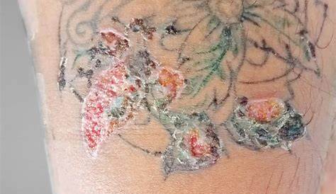 Вердуго Аллергическая на татуировки P 114 + Аллергия на татуировку кожи