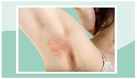Lume Itchy Armpits Как избавиться от Armpit Rash Armpit Rash Подмышечные решетки