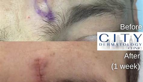 Худший удалённый кистевой ремоулингекс до и после съёмок 895 Орландо и Тампа