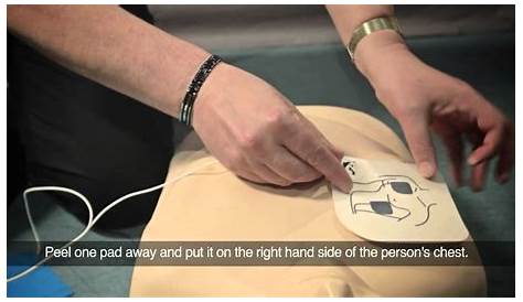 Дефибрилляторы размещены на груди пациента: часть 5 интерактивного тренинга по здоровью